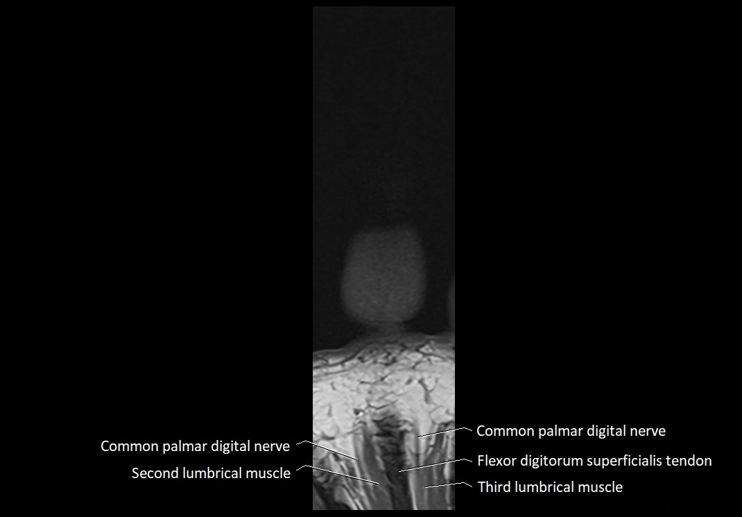Finger anatomy coronal cross section 3TMRI labelled  image 11.webp